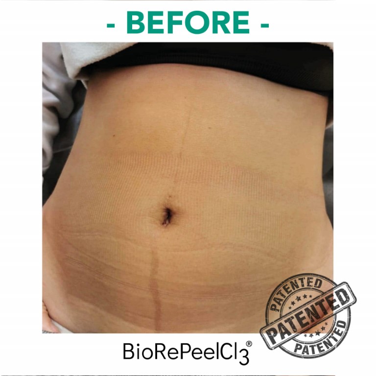 peeling-bioanaplasys-gallery-01