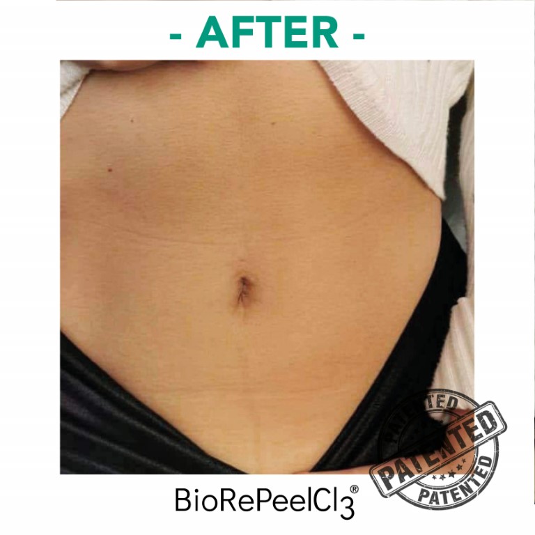 peeling-bioanaplasys-gallery-02