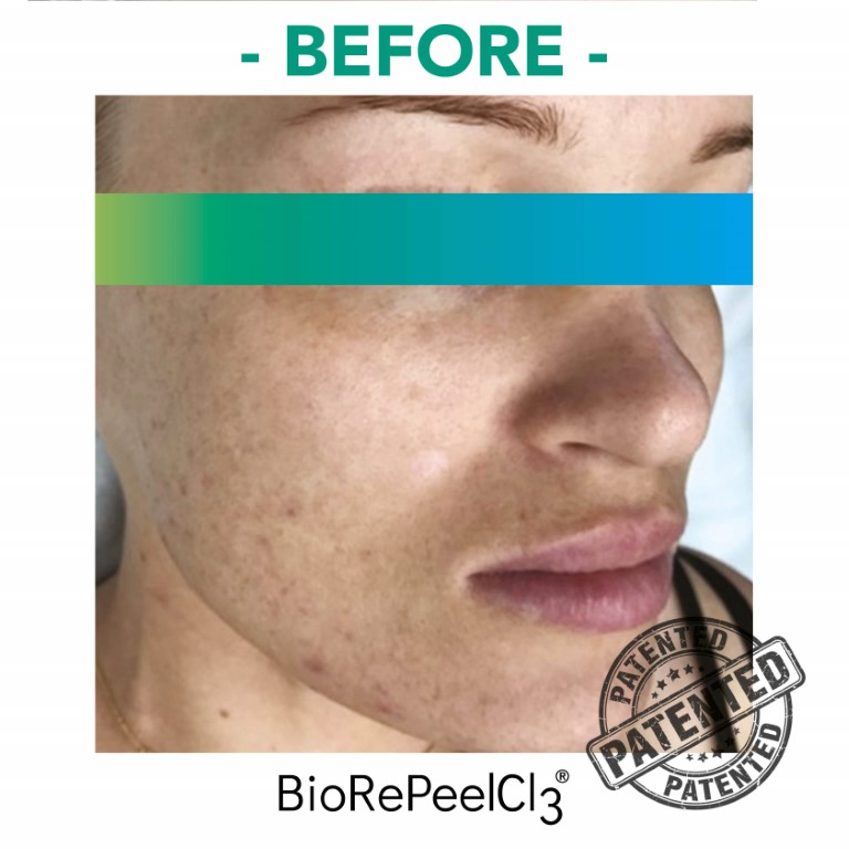 peeling-bioanaplasys-gallery-03