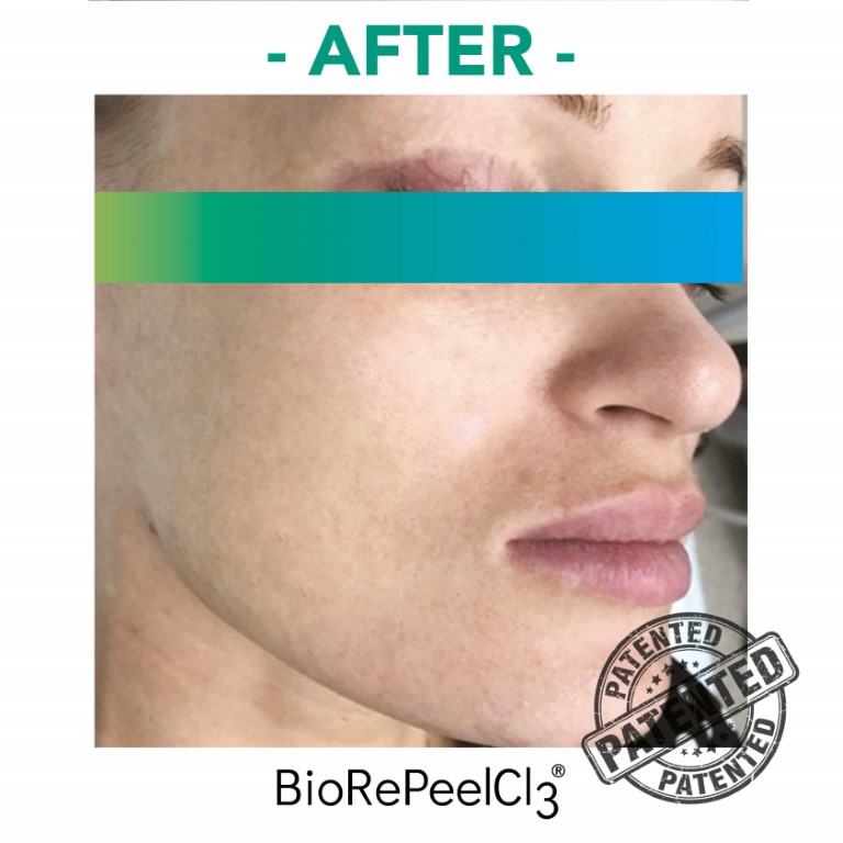 peeling-bioanaplasys-gallery-04