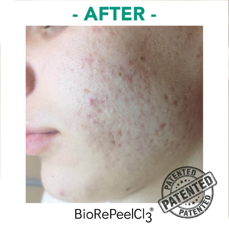 peeling-bioanaplasys-gallery-06