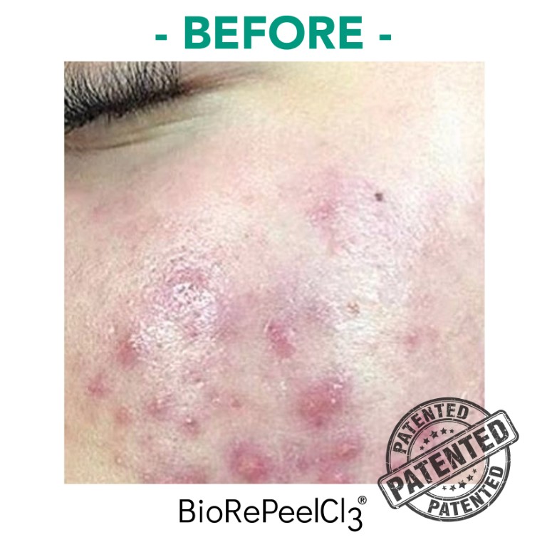 peeling-bioanaplasys-gallery-07