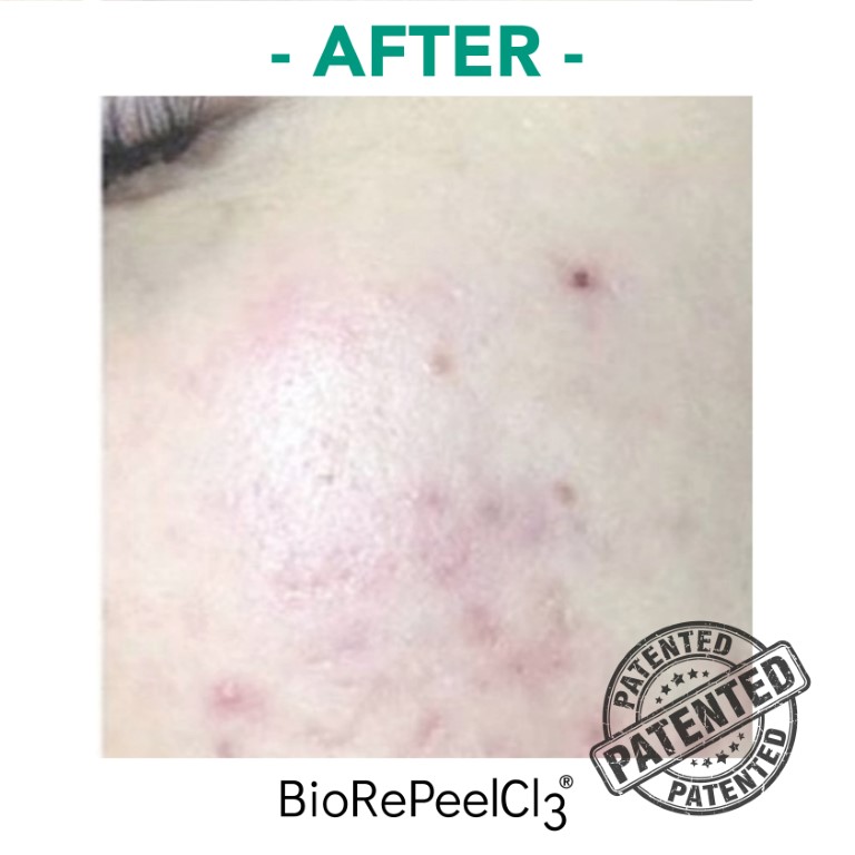 peeling-bioanaplasys-gallery-08