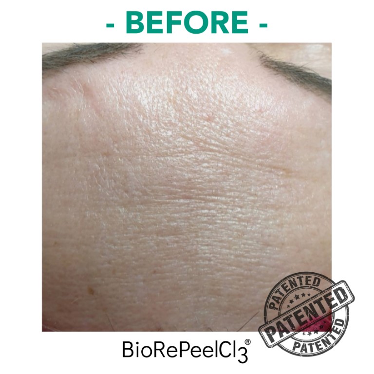 peeling-bioanaplasys-gallery-09