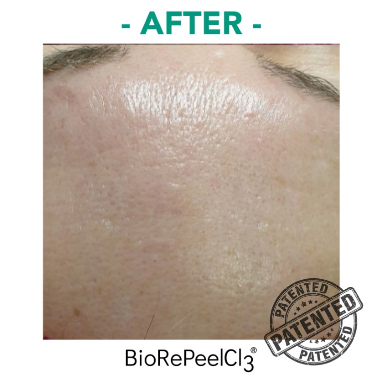 peeling-bioanaplasys-gallery-10