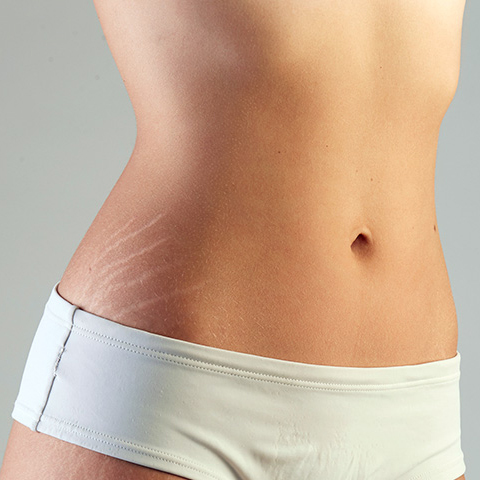 Body Stretch Marks